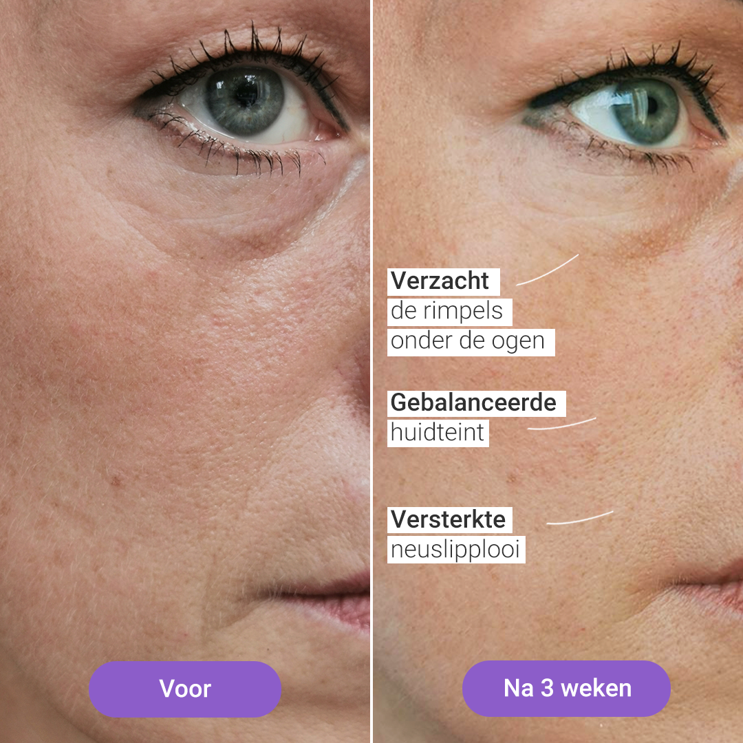 Lichttherapiemasker Lumi